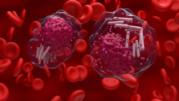 Chronic Lymphocytic Leukemia