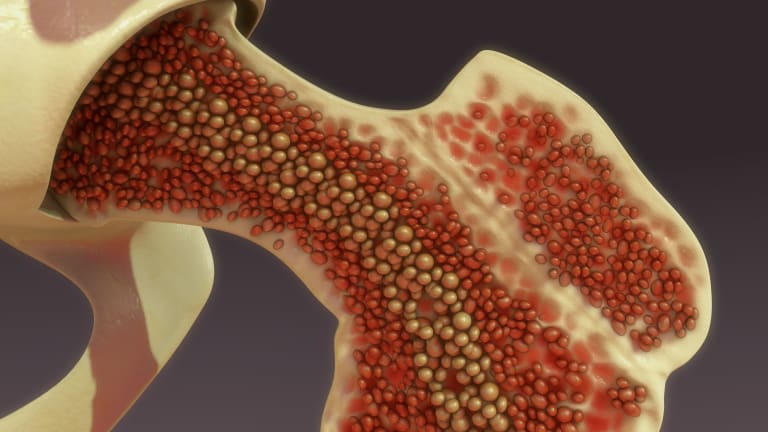 What You Should Know About Bone Marrow Biopsy 
