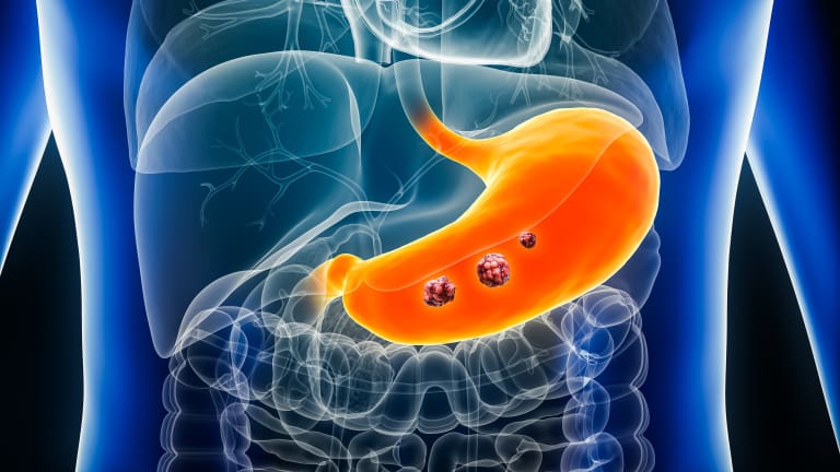 FDA Approves Vyloy Combination For Gastric Or Gastroesophageal Junction ...