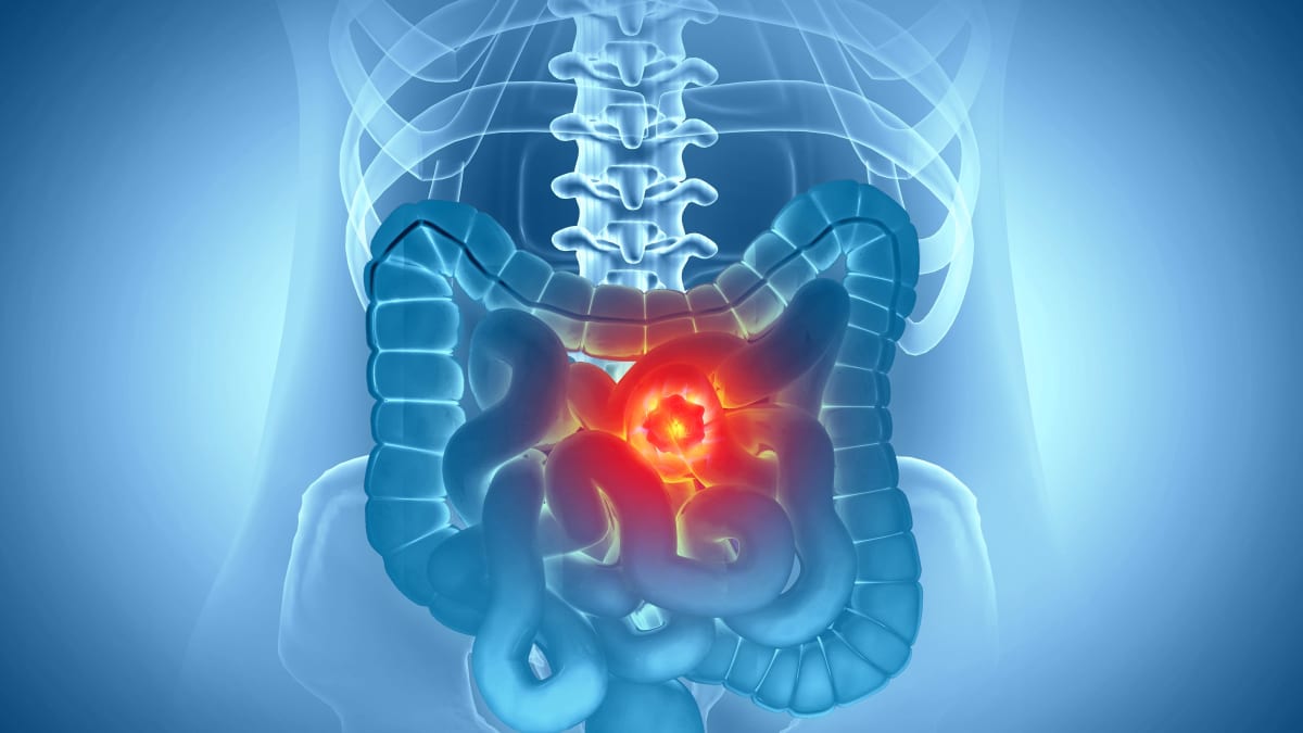 More Evidence for the Role of Immunotherapy in Stage III dMMR Colon Cancer - CancerConnect