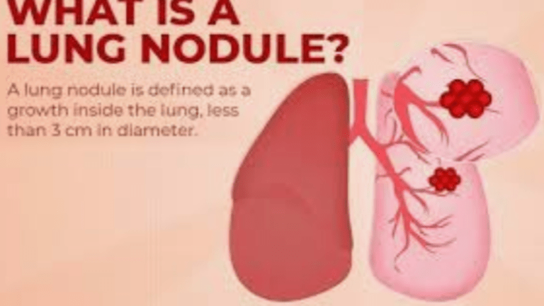 Solitary Pulmonary Nodules and Granulomas