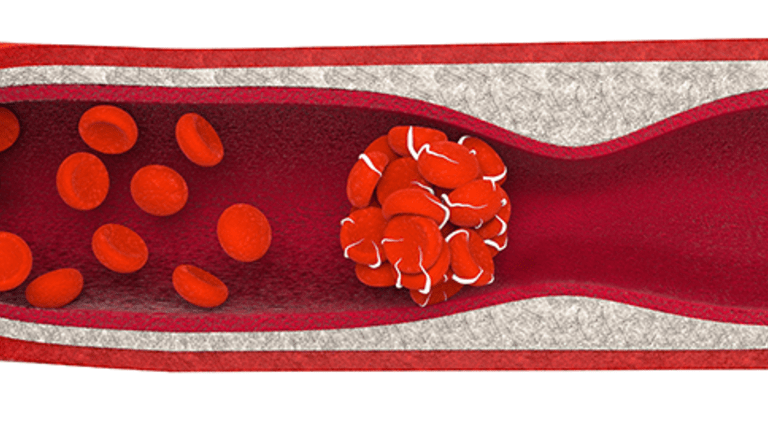 Blood Clots and DVT's - Side Effects of Cancer and its Treatment