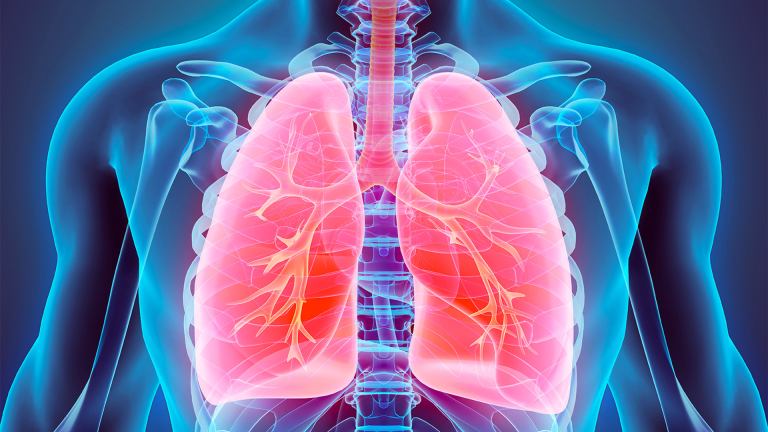 Screening - Prevention & Early Detection of Lung Cancer