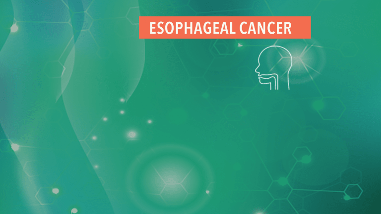 Treatment & Management of Esophageal Cancer
