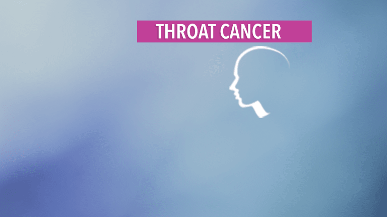 Overview of Throat Cancer