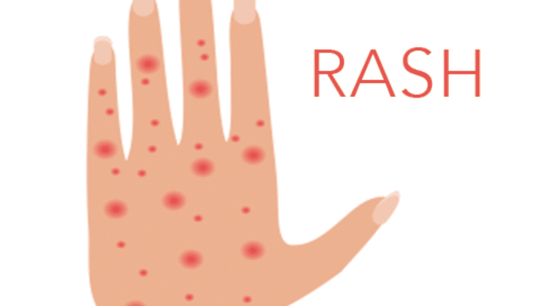 Side Effect of Chemotherapy: Skin Rash