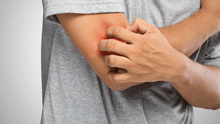 Side Effects of Cancer Treatment: Itching (Pruritus) Overview
