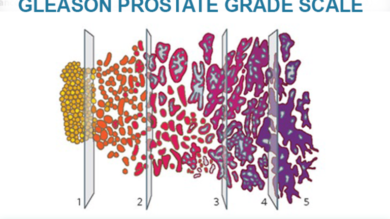 adenocarcinoma prostate gleason 6