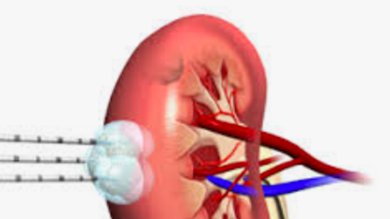 Radiofrequency Ablation Effective For Small Kidney Cancers