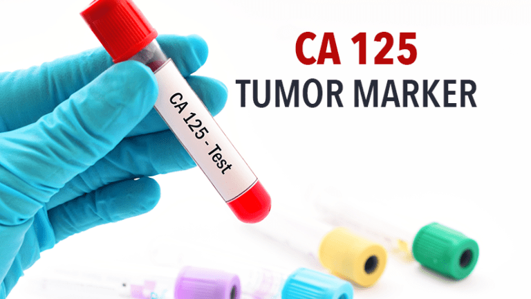The CA 125 “tumor associated protein” or “tumor marker”