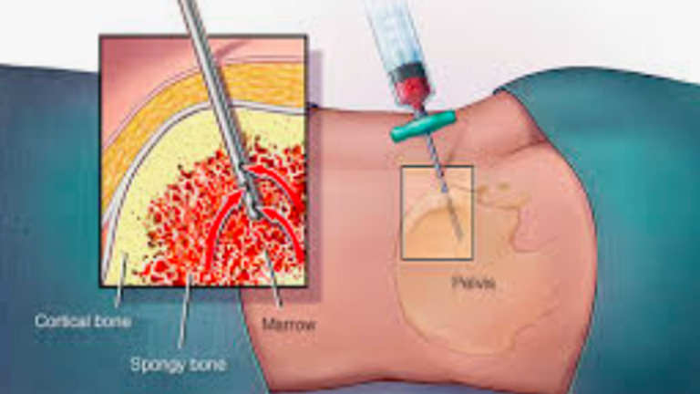 What You Should Know About Bone Marrow Biopsy