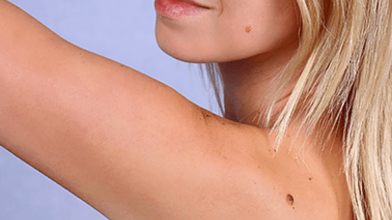 Recognize The Early Signs of Skin Cancer 
