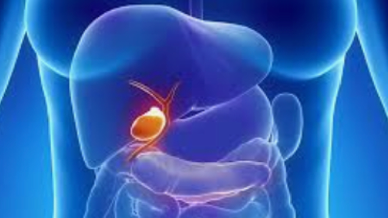 klatskin tumor stages of