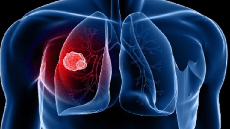 Precision Cancer Medicines & Immunotherapy  for Lung Cancer