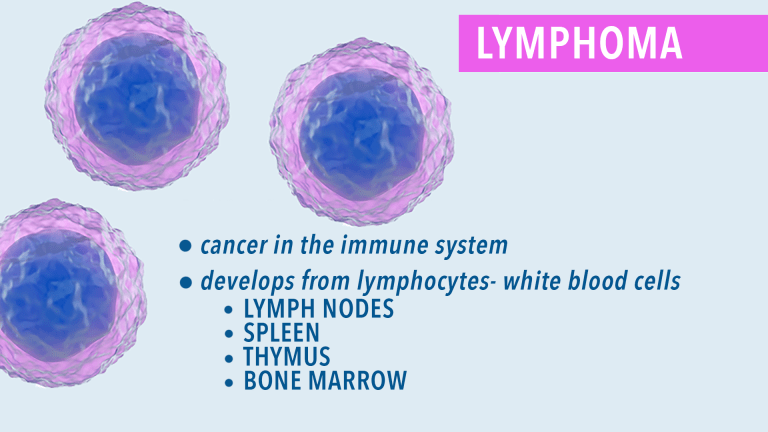 Lymphoma Classifications - CancerConnect