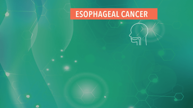 stage 4 esophageal cancer no treatment