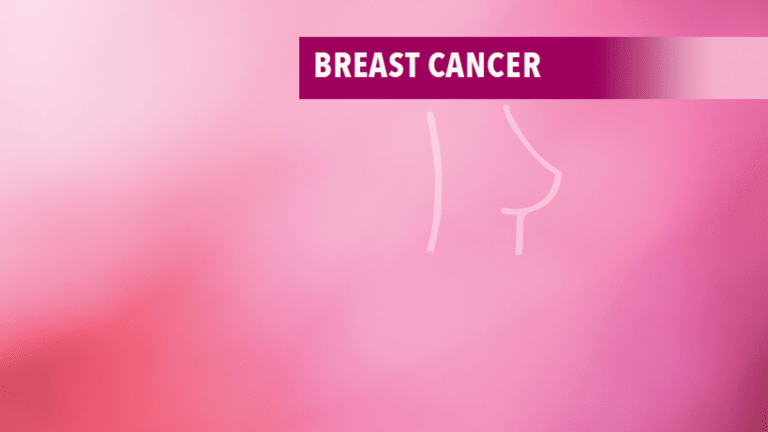 Breast cancer screening and treatment