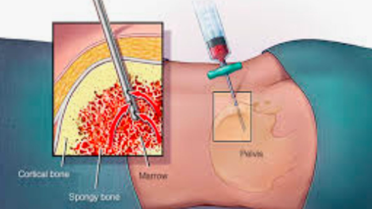 What You Should Know About Bone Marrow Biopsy Cancerconnect