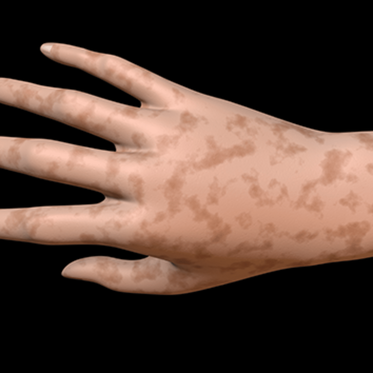 Side Effects of Cancer Treatment: Hyperpigmentation - CancerConnect