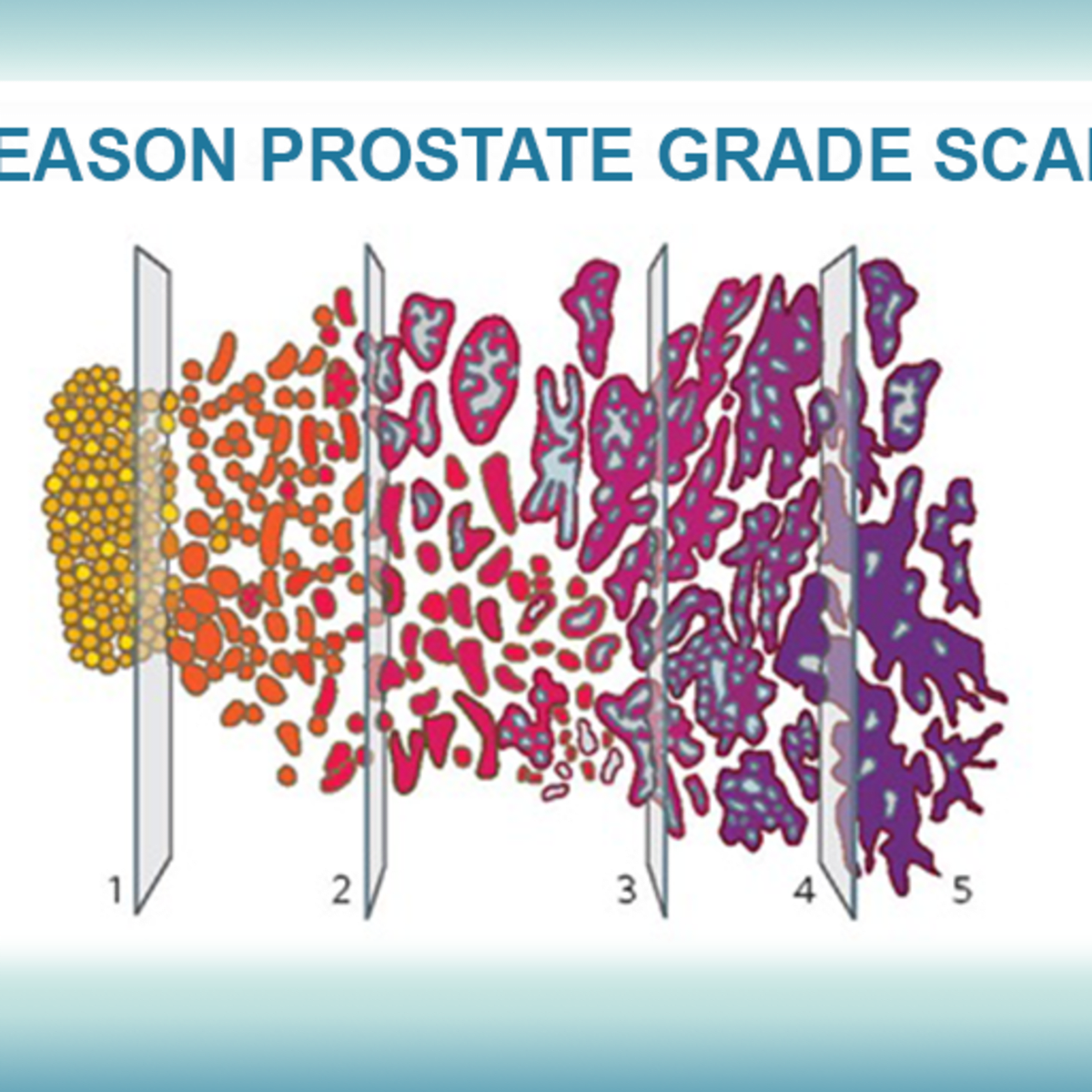 prostate cancer stage 2 gleason score 7