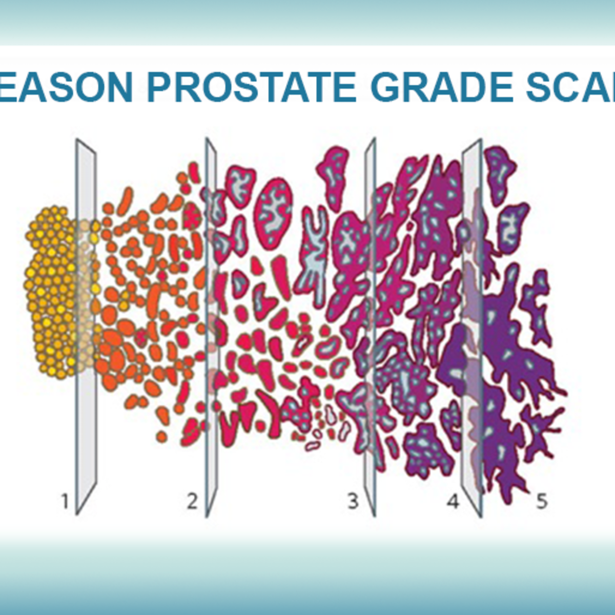 adenocarcinoma de prostata gleason 7 34)