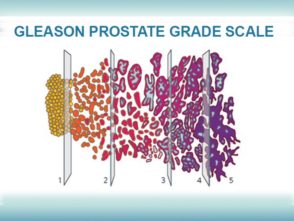 adenocarcinoma prostate gleason score 33 6 treatment