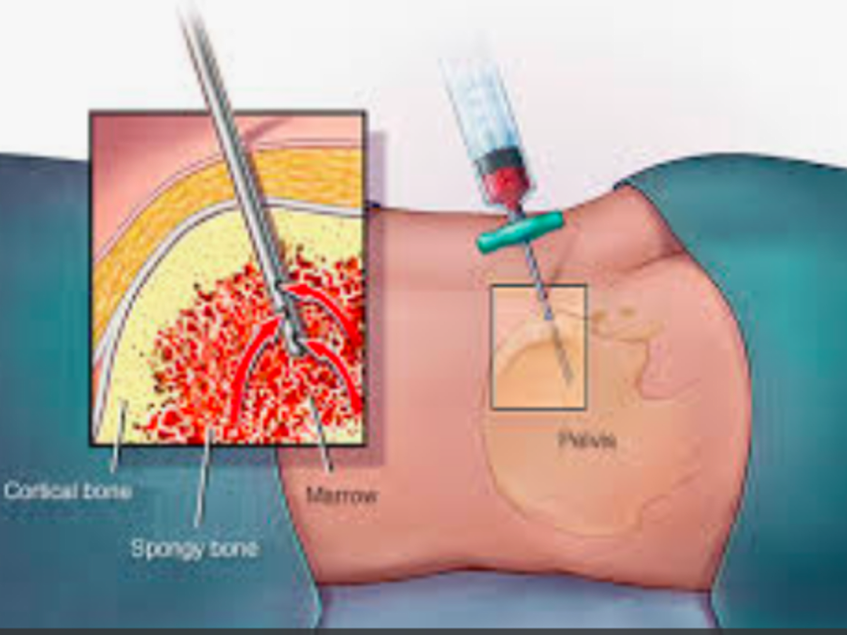 What You Should Know About Bone Marrow Biopsy Cancerconnect