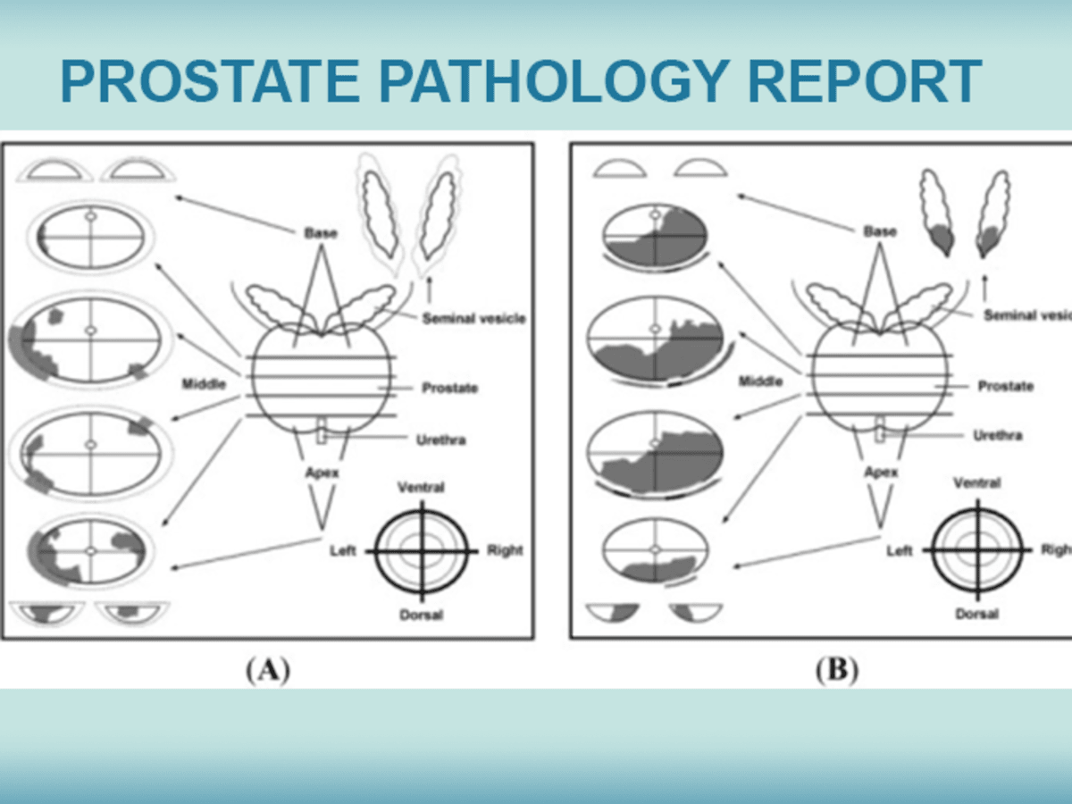 pathology of prostate cancer)