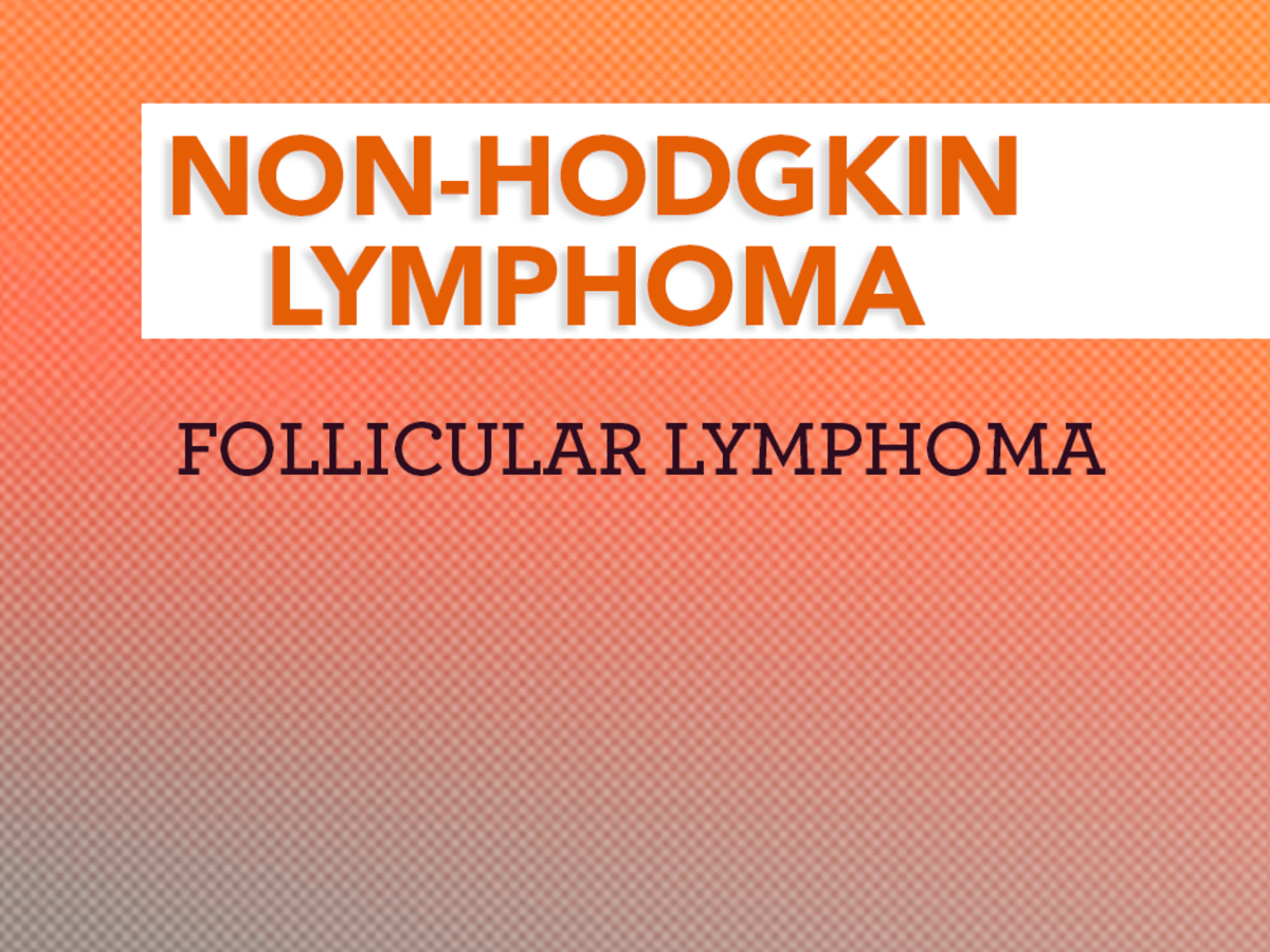 Treatment Of Stages Iie Iv Follicular Lymphoma Cancerconnect