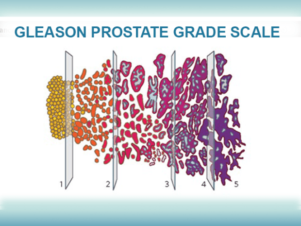 adenocarcinoma prostate gleason score 6 33