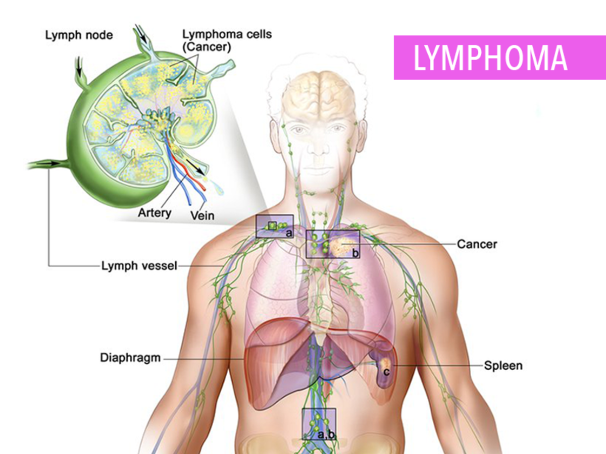 location of lymph nodes lymphoma