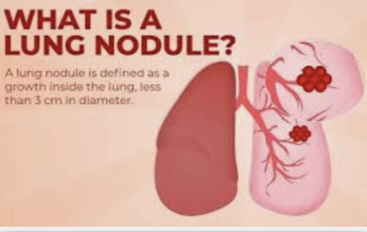 solitary-pulmonary-nodules-and-granulomas-cancerconnect