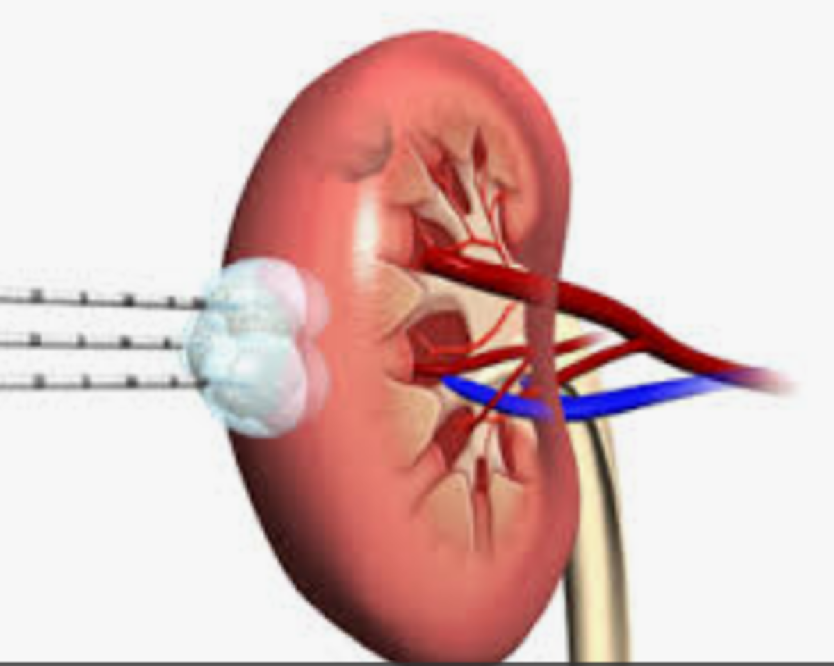 Radiofrequency Ablation Effective For Small Kidney Cancers CancerConnect