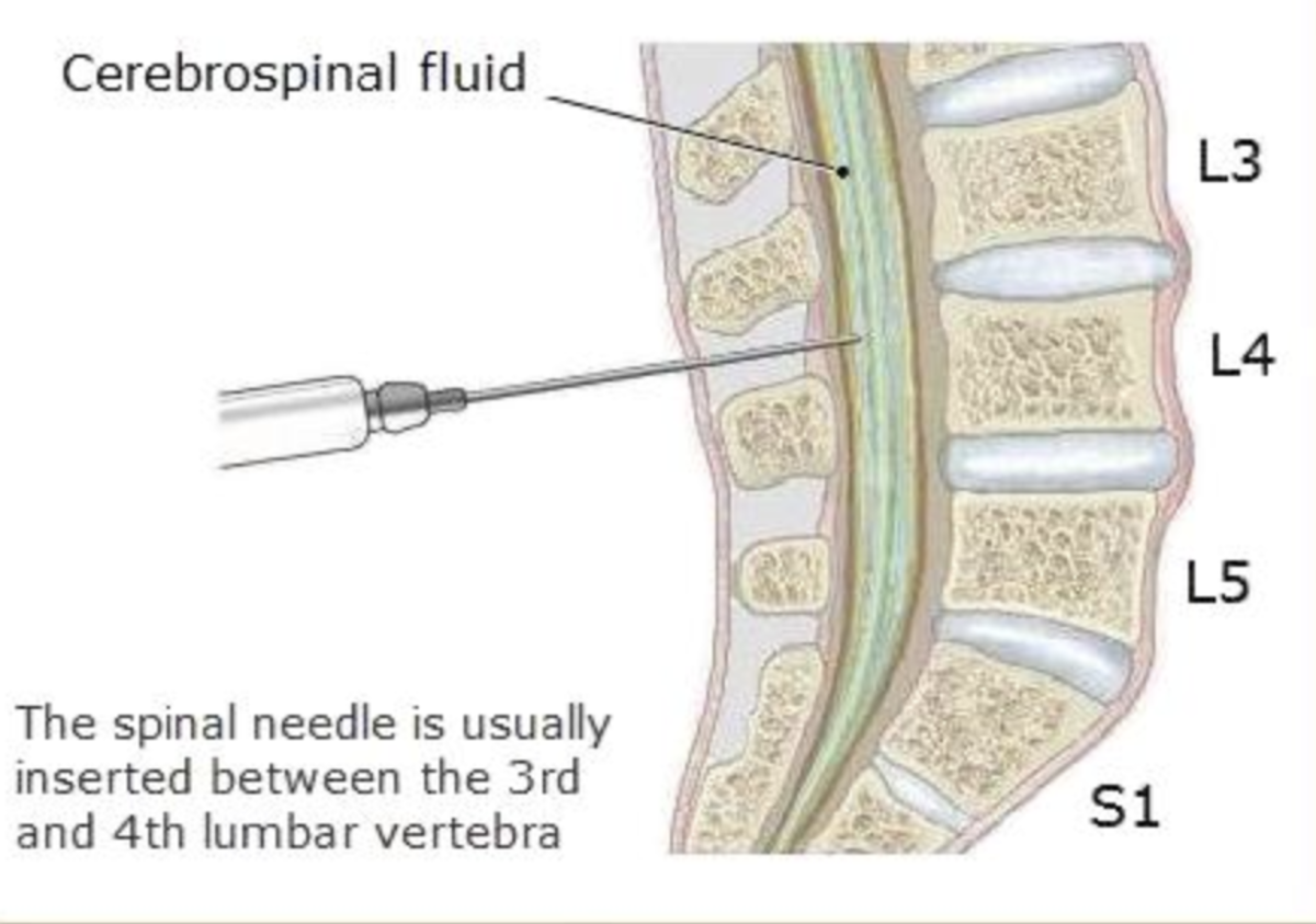 Lumbar Puncture Anatomy