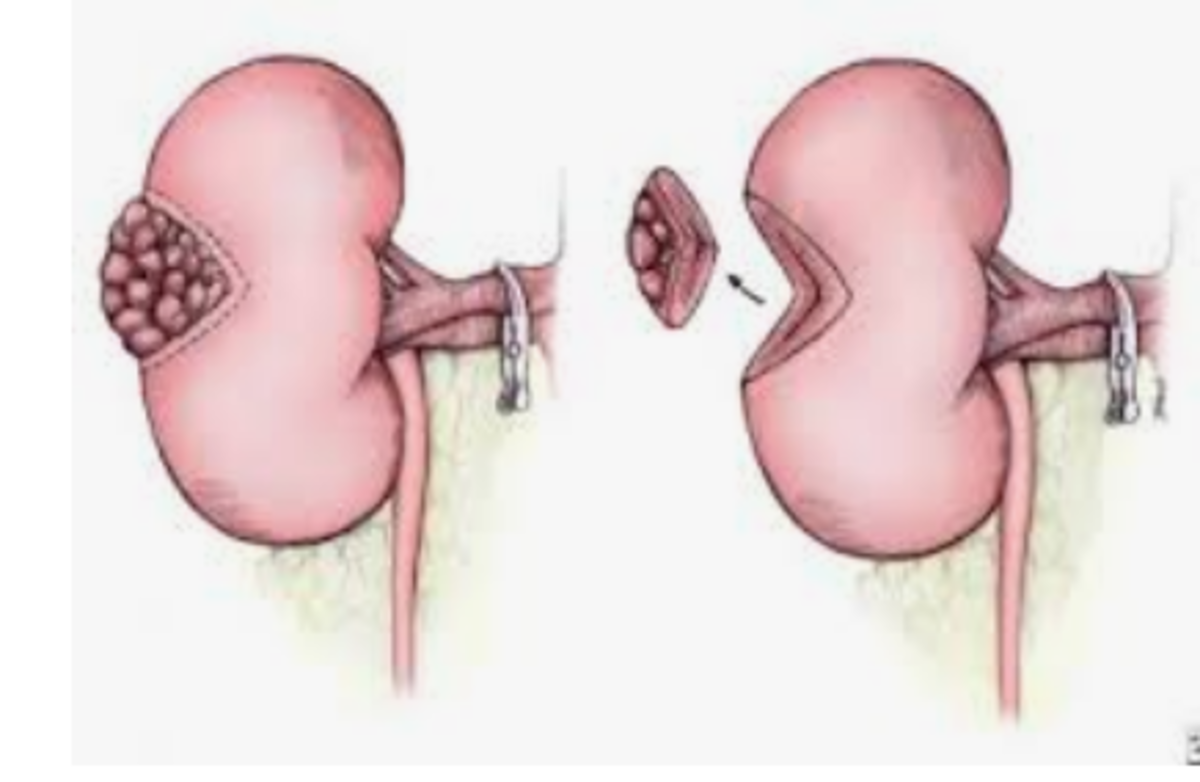 right-versus-left-laparoscopic-donor-nephrectomy-initial-3-year